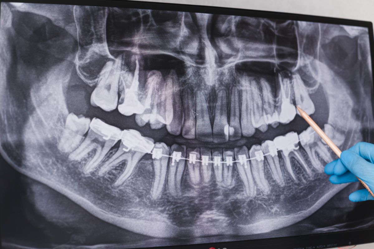 Doctor Points To Cured Filled Tooth In Dental X Ra 2021 08 30 02 13 57 Utc