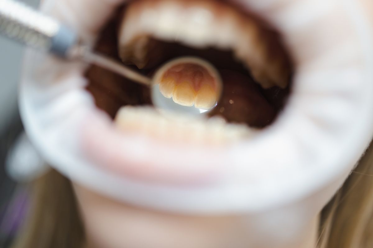 Closeup Of Client S Teeth Being Scaled And Polishe 2022 05 13 01 04 52 Utc