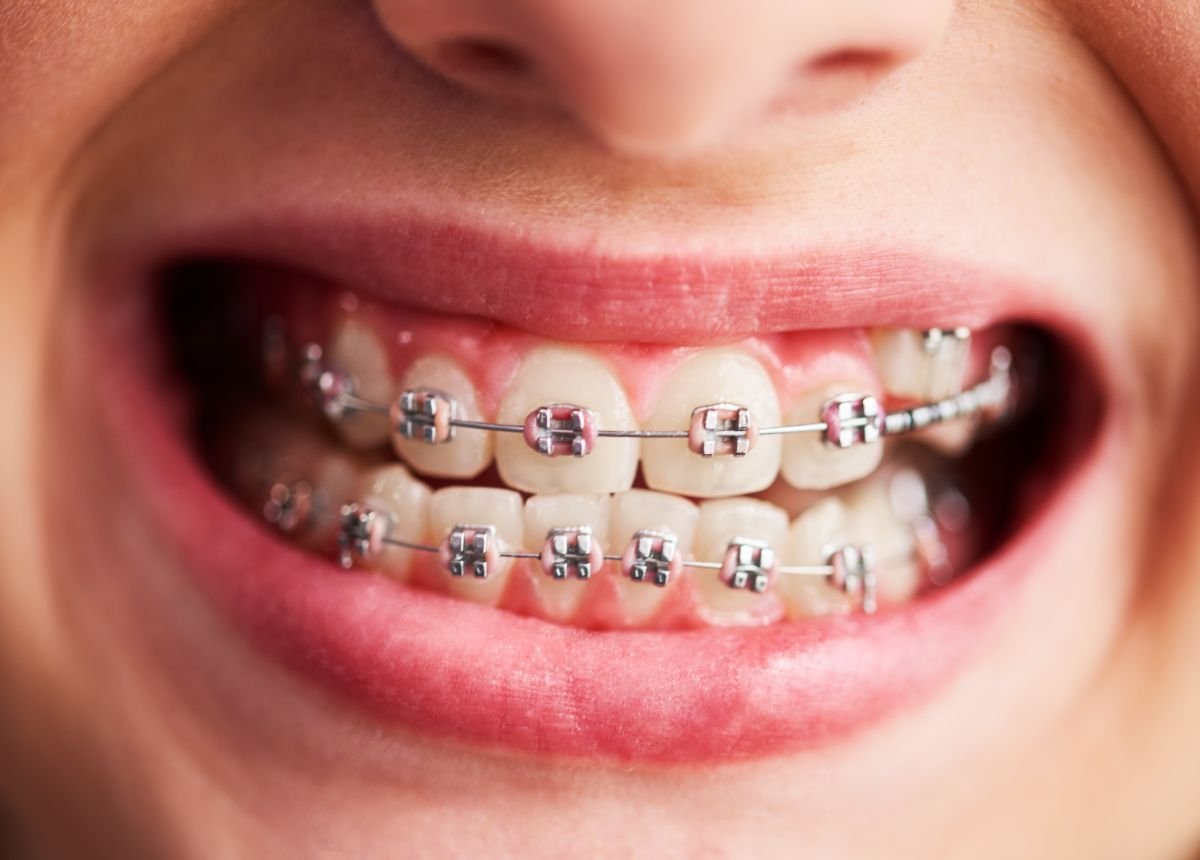 Shot Of Child S Teeth With Braces 2021 08 27 09 55 56 Utc